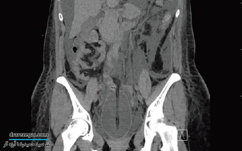 همه چیز درباره پارگی مثانه