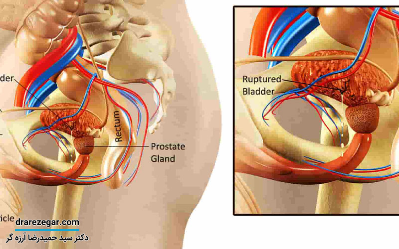 همه چیز درباره پارگی مثانه
