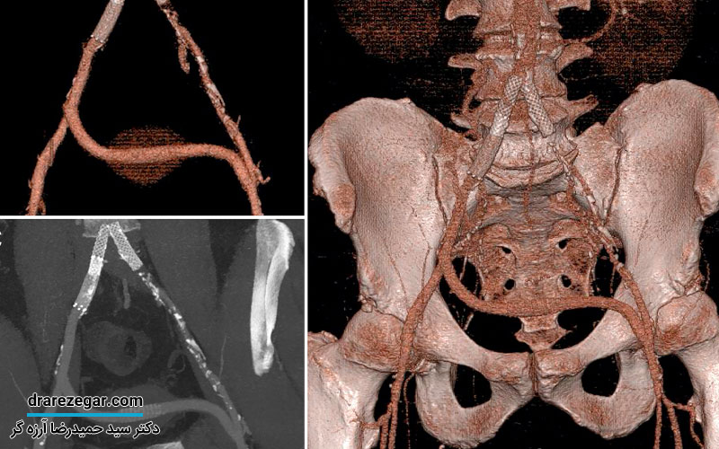 همه چیز درباره پارگی مثانه