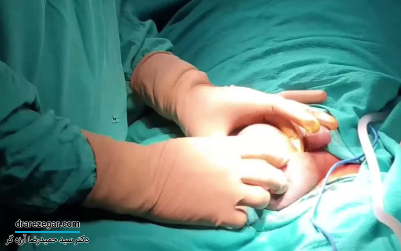 عمل جراحی هیدروسل در نوزادان پسر