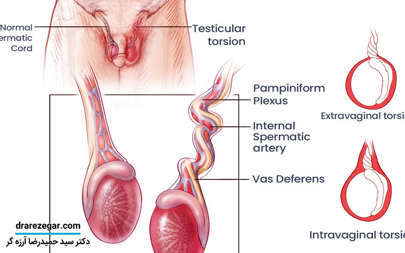 پیچ خوردگی بیضه (پیچش بیضه) چیست