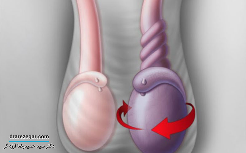 پیچ خوردگی بیضه (پیچش بیضه) چیست