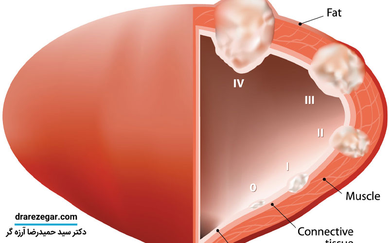 درمان تومور مثانه