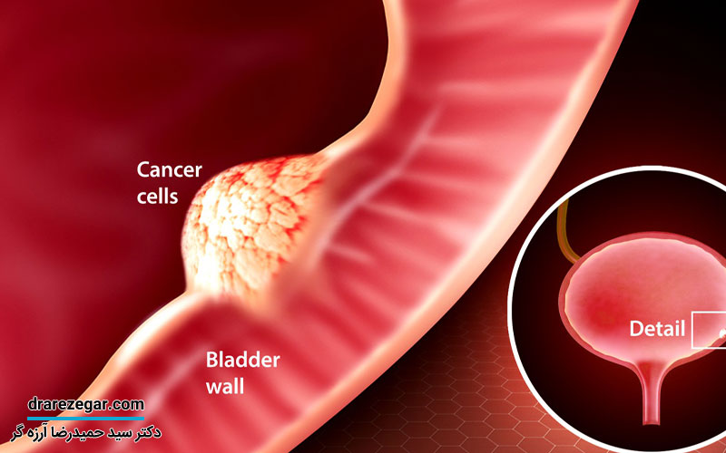 درمان تومور مثانه
