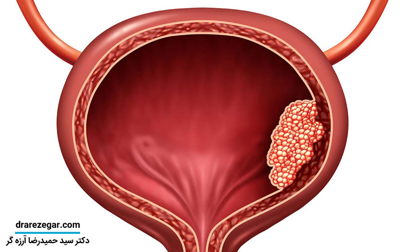 درمان تومور مثانه