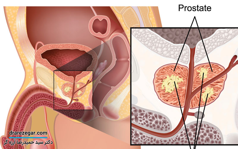 علائم سرطان پروستات