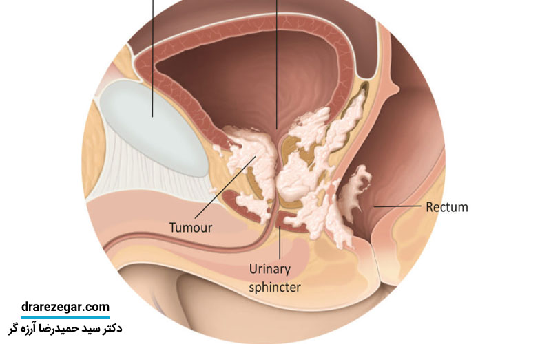 علائم سرطان پروستات
