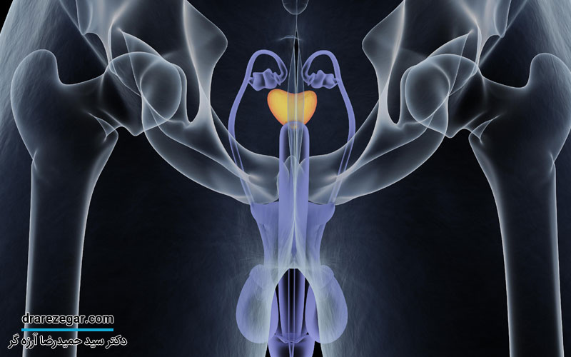 علائم سرطان پروستات