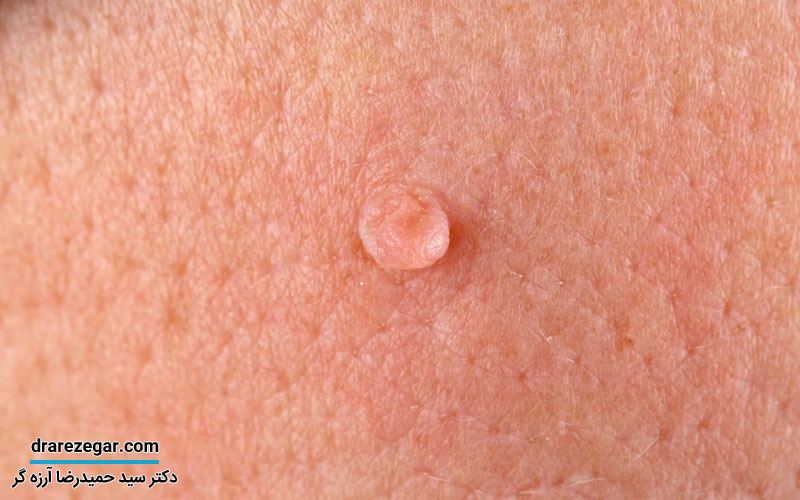 علت زگیل تناسلی در آقایان