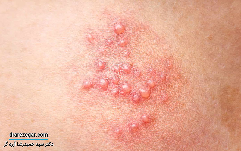 علت زگیل تناسلی در آقایان