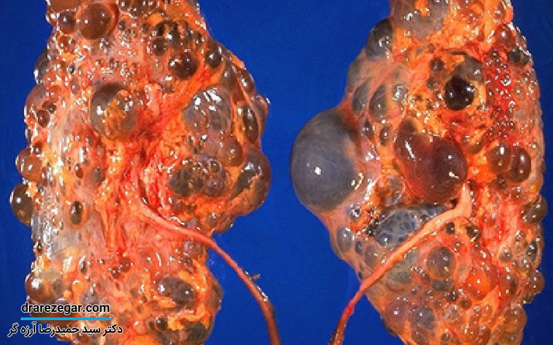 کلیه پلی کیستیک چیست