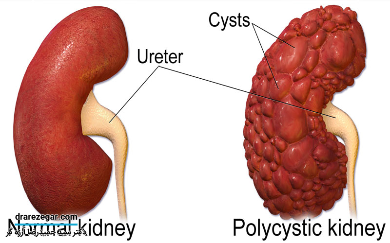کلیه پلی کیستیک چیست