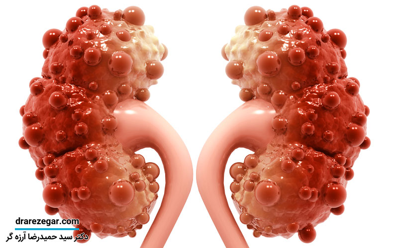 کلیه پلی کیستیک چیست