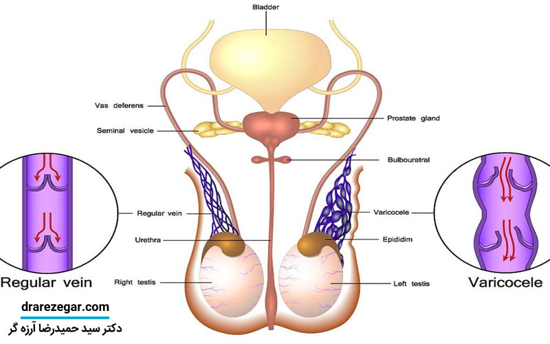 واریس بیضه چیست