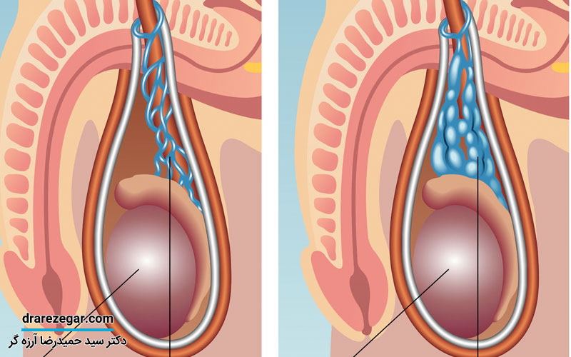 واریس بیضه چیست