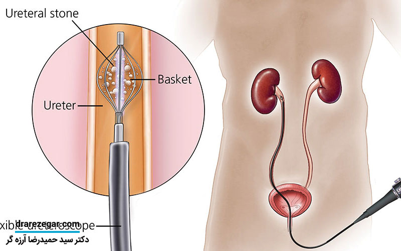 علل و علائم سرطان حالب