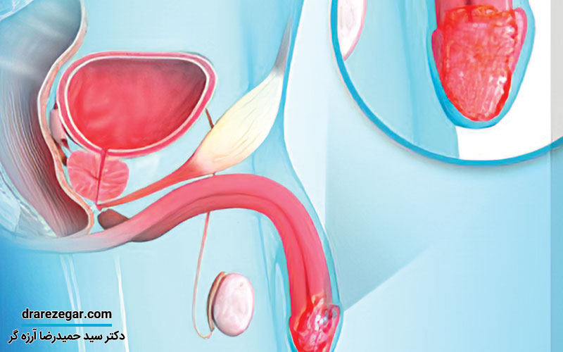 سرطان آلت تناسلی در مردان