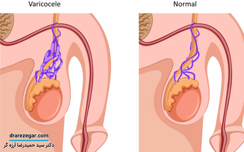 علائم آتروفی بیضه