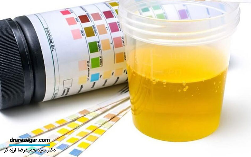 درمان رسوبات ادراری