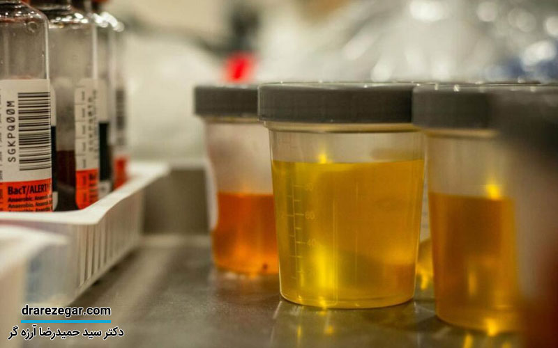 درمان رسوبات ادراری