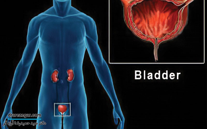 سندرم مثانه دردناک چیست