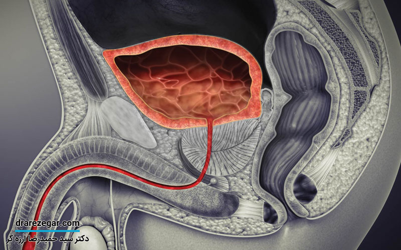 علائم سنگ مثانه