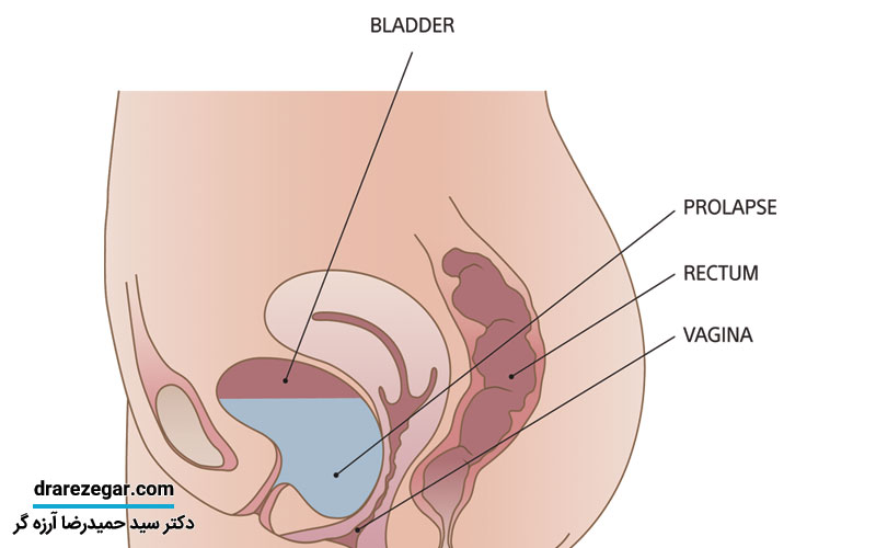 علت افتادگی مثانه چیست