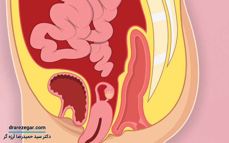 علت افتادگی مثانه چیست