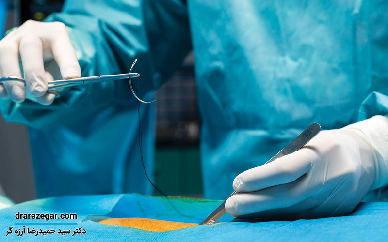 جراحی کیسه بیضه