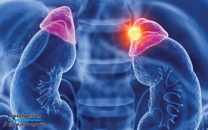 کیست آدرنال چیست