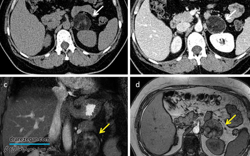 کیست آدرنال چیست