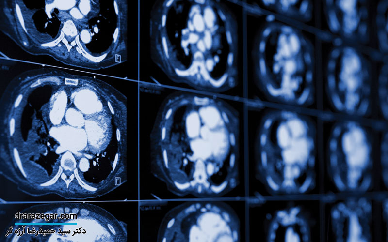 کیست آدرنال چیست