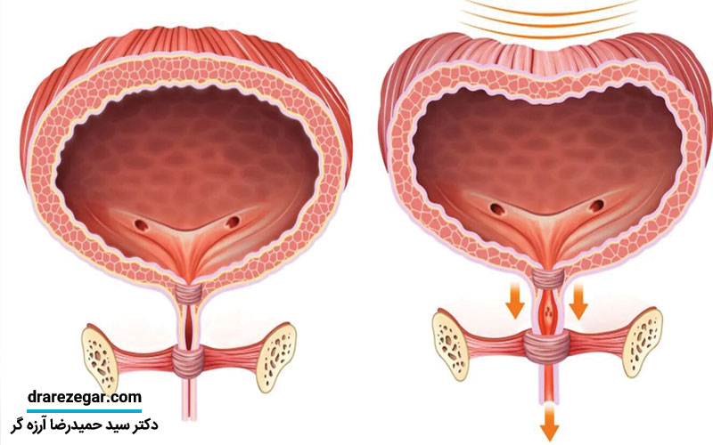 احتباس ادراری چیست