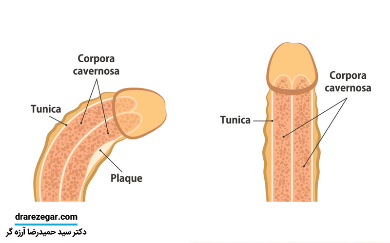 علت بیماری پیرونی در مردان چیست