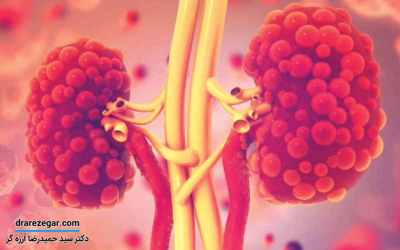 علائم نارسایی خفیف کلیه