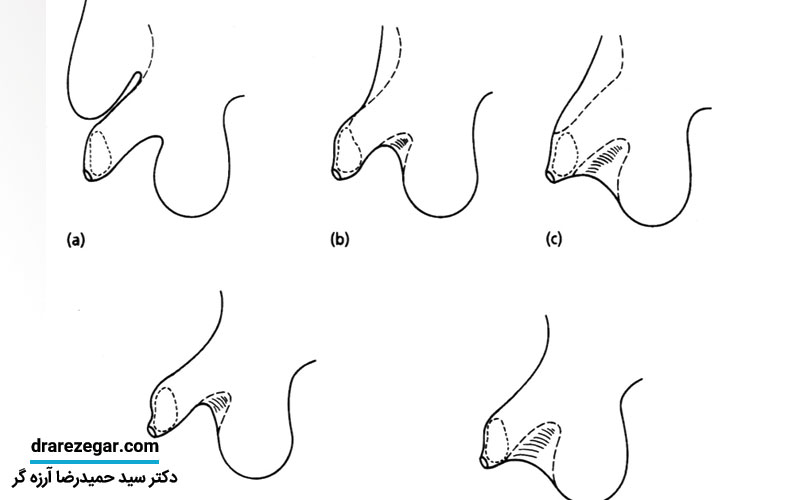 آلت تناسلی پرده دار چیست