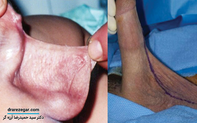 آلت تناسلی پرده دار چیست