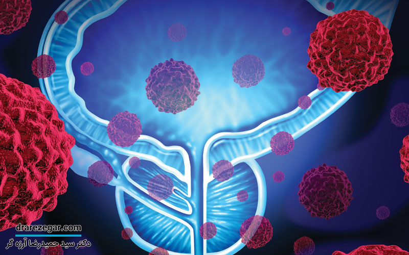 دلیل مبتلا شدن به پروستات