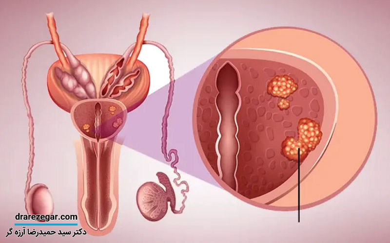 دلیل مبتلا شدن به پروستات