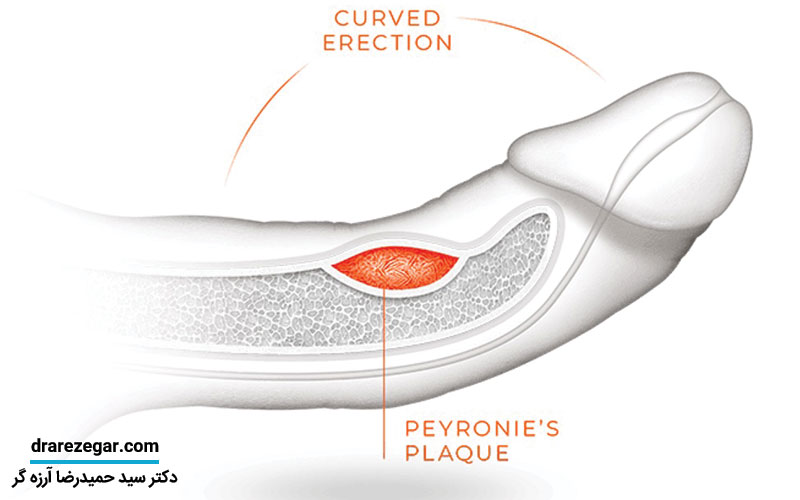 درمان خمیدگی و کجی آلت تناسلی