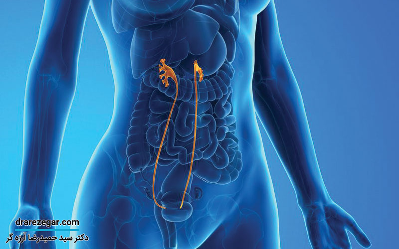 بیماری کلیه دوبلکس چیست