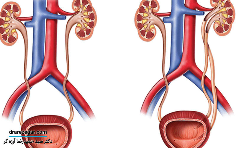 بیماری کلیه دوبلکس چیست