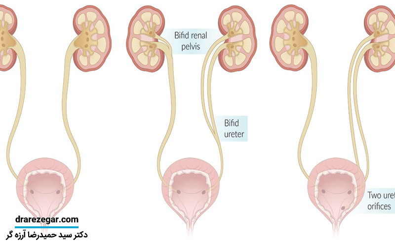 بیماری کلیه دوبلکس چیست