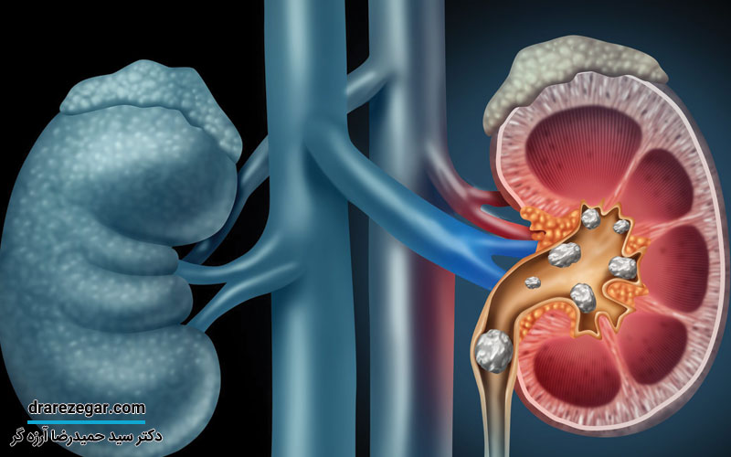 عوارض نوشیدنی های انرژی زا بر کلیه