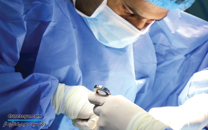 عمل پیلوپلاستی