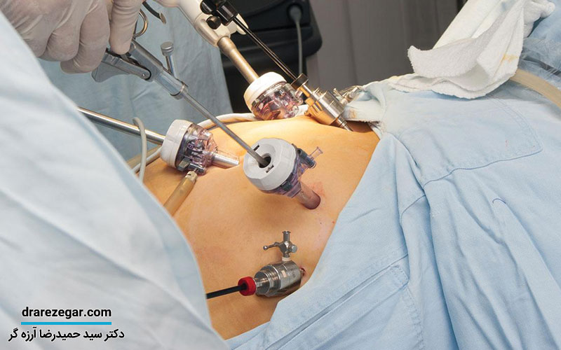 عمل پیلوپلاستی