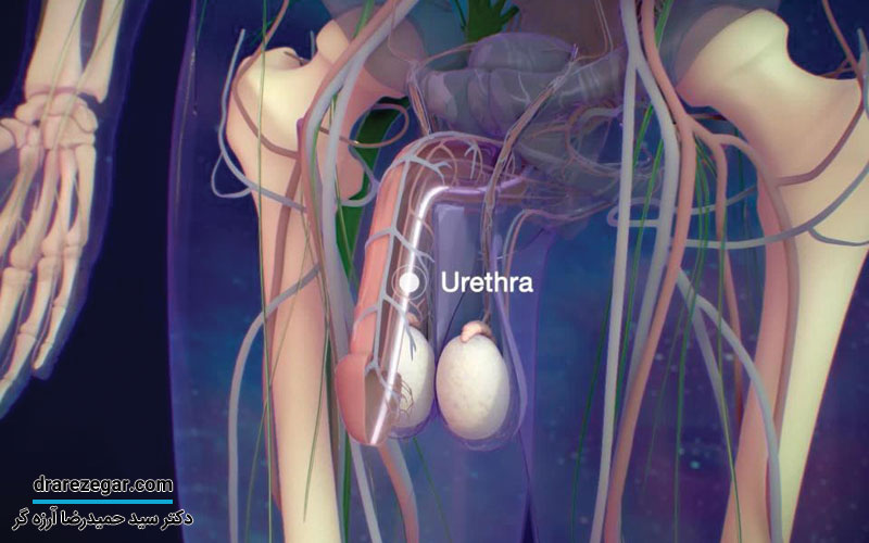 علل ایجاد تنگی مجرای ادرار