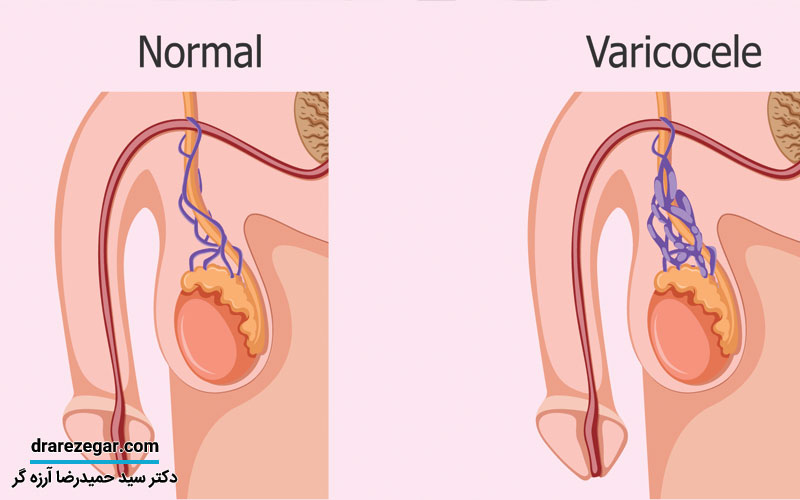 آیا تنها درمان واریکوسل جراحی است