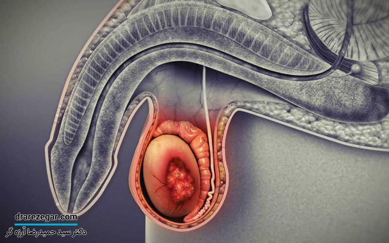 روش های تشخیص و درمان تومور بیضه