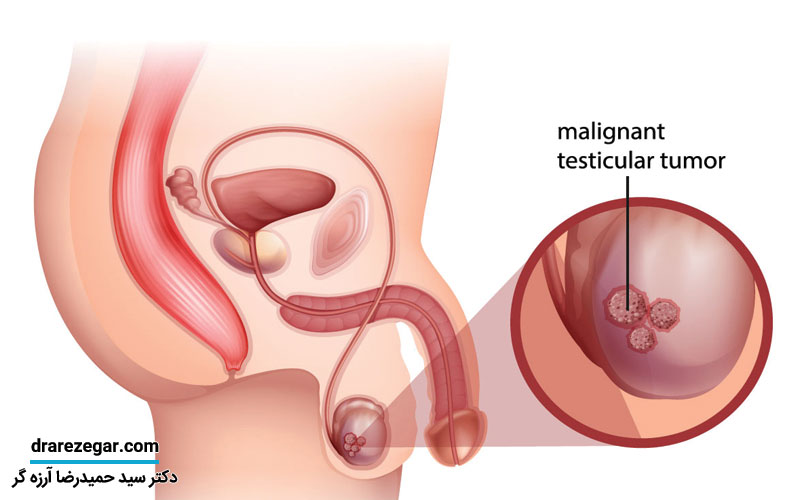 روش های تشخیص و درمان تومور بیضه